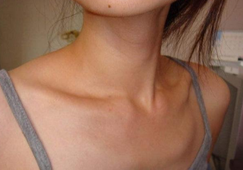 锁骨形状有哪几类